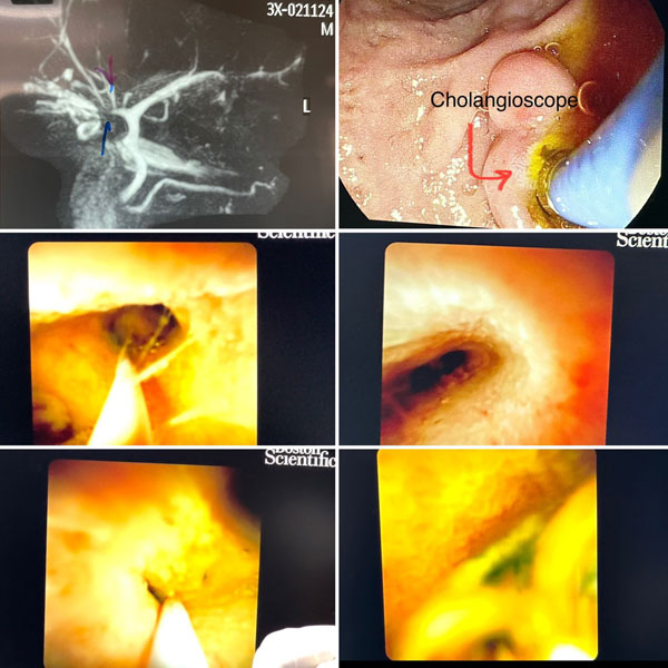 case study by Dr. Gajanan Rodge, Gastroenterologist at Bombay Hospital and Medical Research Institute in South Mumbai with special skills in the field of endoscopy.