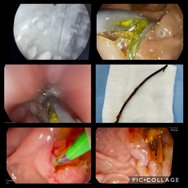case study by Dr. Gajanan Rodge, Gastroenterologist at Bombay Hospital and Medical Research Institute in South Mumbai with special skills in the field of endoscopy.
