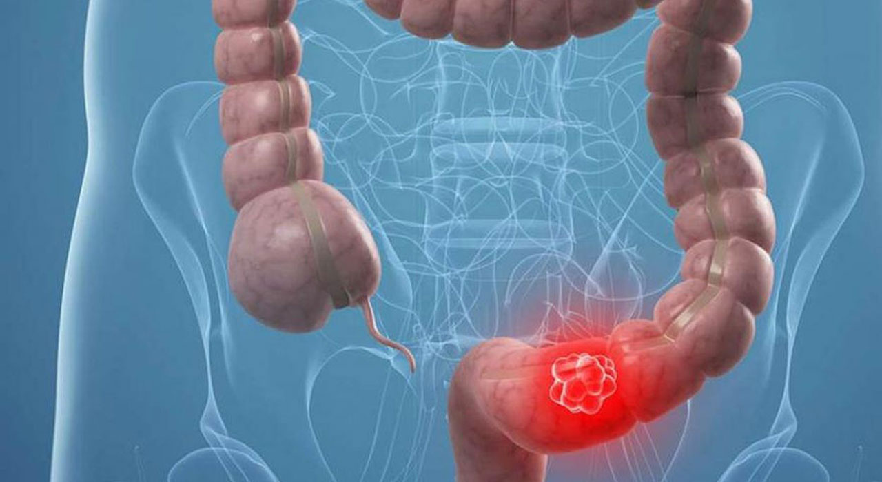 colon cancer related treatment and service by Dr. Gajanan Rodge, best gastroenterologists in Mumbai