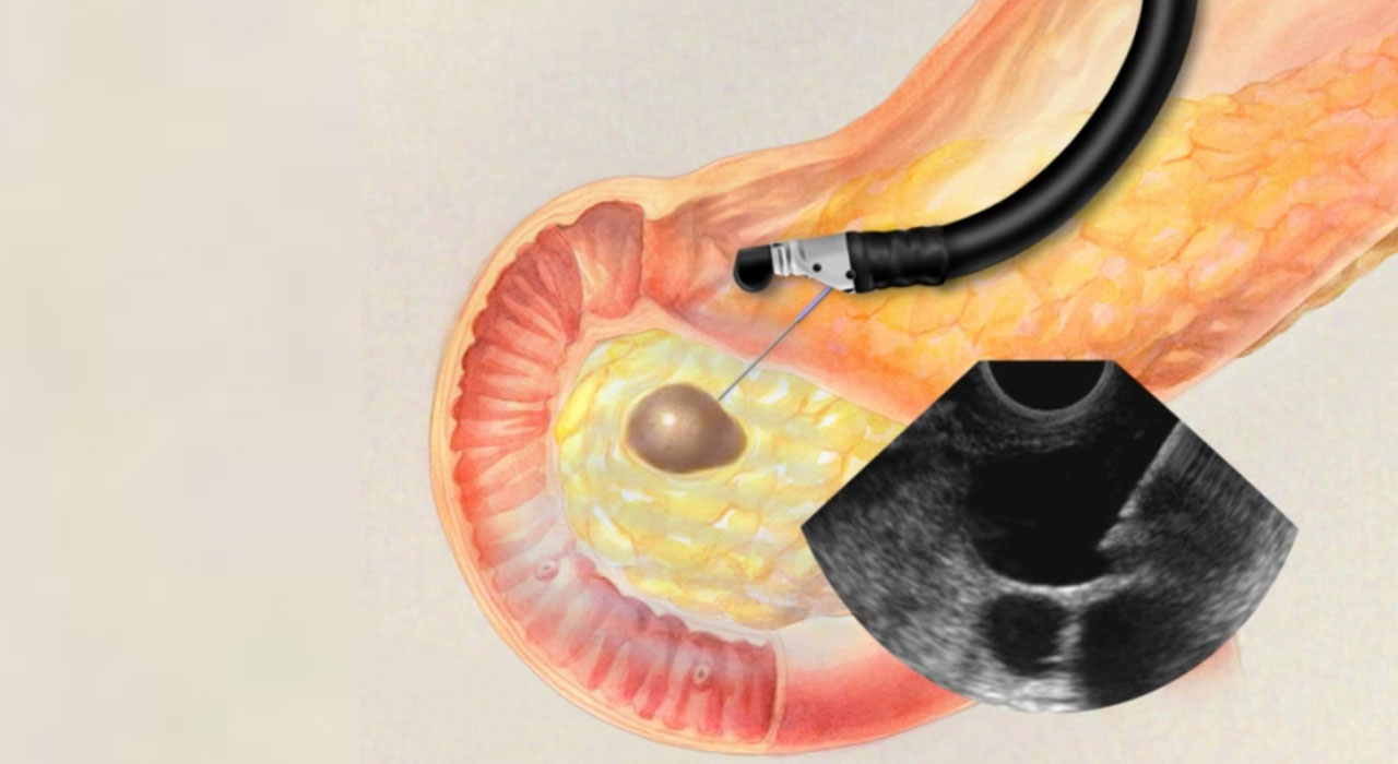 endoscopic ultrasound procedure related treatment and service by Dr. Gajanan Rodge, best gastroenterologists in Mumbai