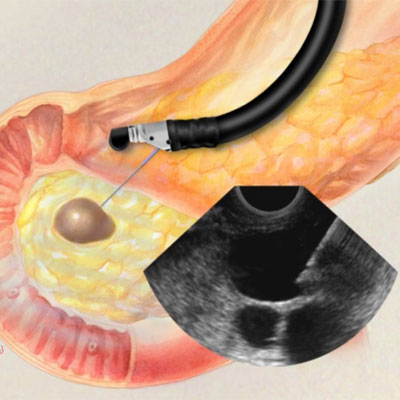 https://www.drgajananrodge.com/resources/assets/images/services/endoscopic-ultrasound-procedure-service-img.jpg	endoscopic ultrasound procedure related treatment and service by Dr. Gajanan Rodge, best gastroenterologists in Mumbai