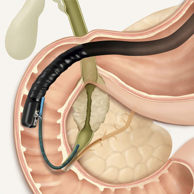 ercp procedure related treatment and service by Dr. Gajanan Rodge, best gastroenterologists in Mumbai