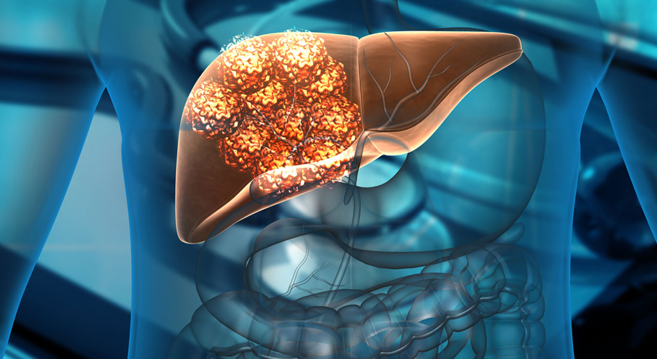 liver cancer related treatment and service by Dr. Gajanan Rodge, best gastroenterologists in Mumbai