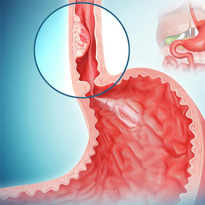 oesophageal dilation procedure related treatment and service by Dr. Gajanan Rodge, best gastroenterologists in Mumbai