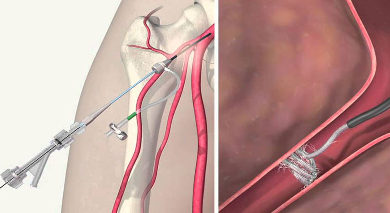 variceal banding procedure related treatment and service by Dr. Gajanan Rodge, best gastroenterologists in Mumbai